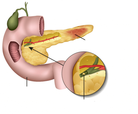 pancreatitis er en betændelse i bugspytkirtlen